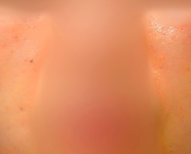 분당 지루성피부염 치료 후 · 32세 여성 · 치료 기간 5개월