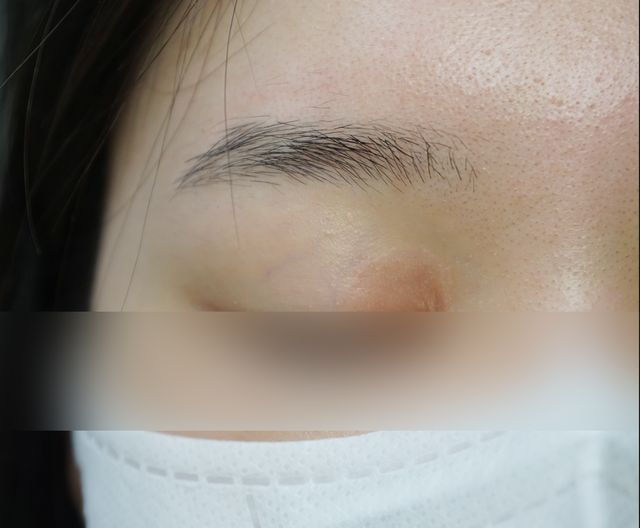 20세 여성 · 7개월 경과 · 치료 전