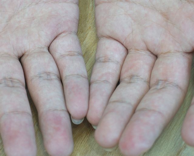 분당 아토피 치료 후 · 20세 남성 · 치료 기간 10개월