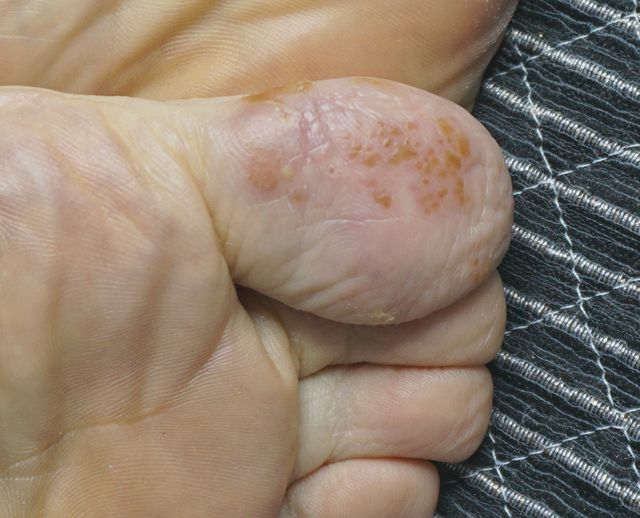 분당 한포진 치료 전 · 66세 여성