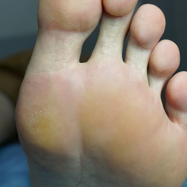 분당 사마귀 치료 후 · 47세 남성 · 치료 기간 1년